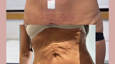 Mini Tummy Tuck Surgery Before and After | Stunning Transformation