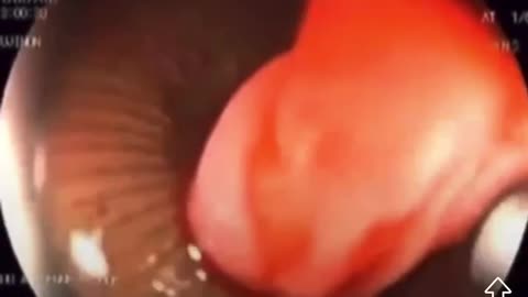 A leech caught in a person's airway. And people believe we don’t get parasites.