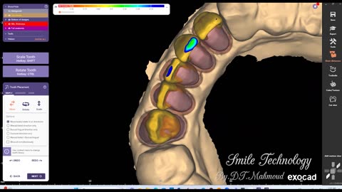 #design #naildesign #dental #dentaldesign #exocadexpert