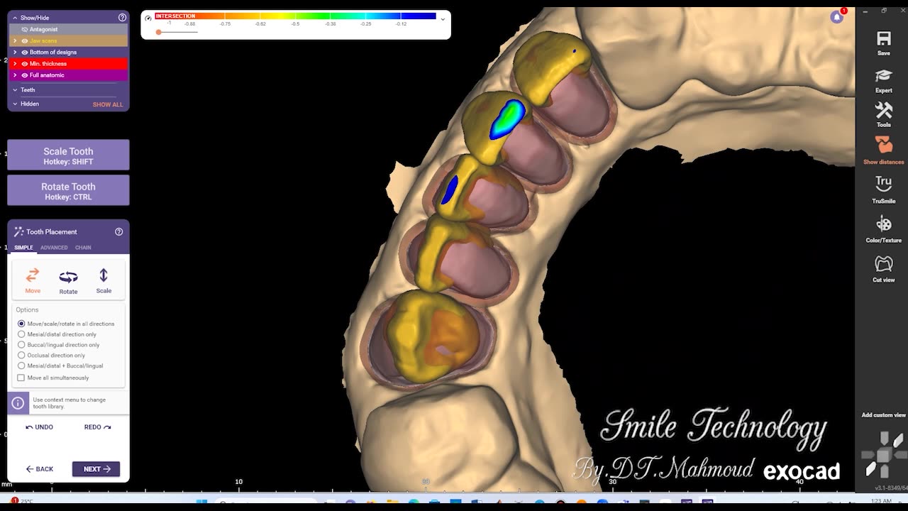 #design #naildesign #dental #dentaldesign #exocadexpert