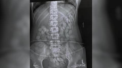 S. Africa police arrest woman with over 60 'drug bullets' in stomach