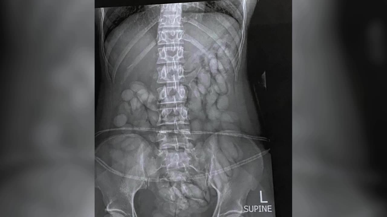 S. Africa police arrest woman with over 60 'drug bullets' in stomach