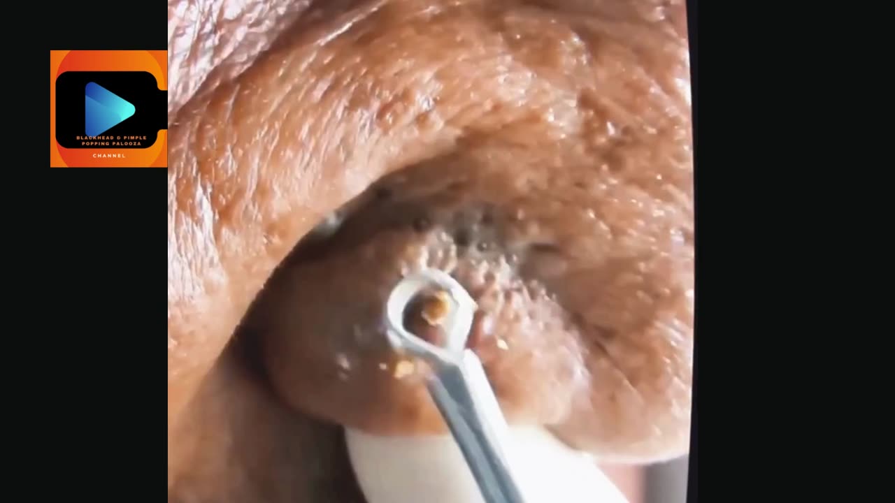 A satisfying blackhead removal from nose