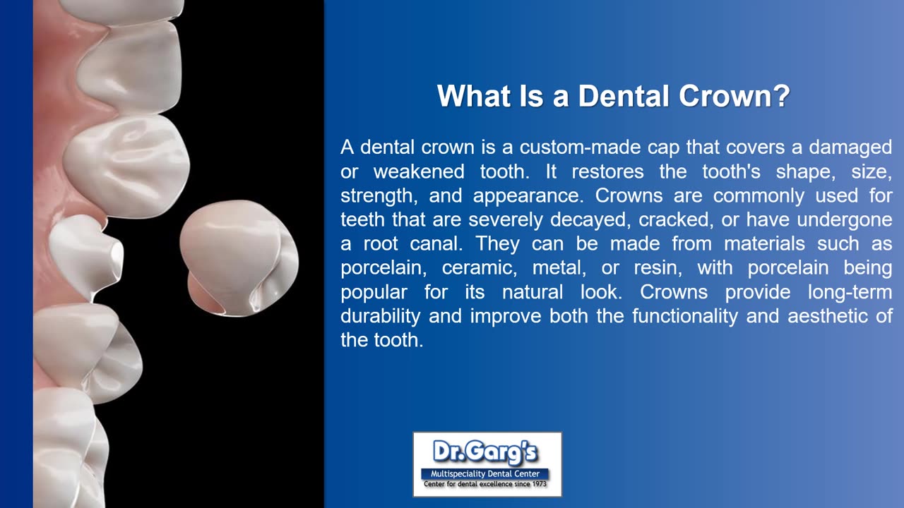 The Magic Behind Dental Crowns