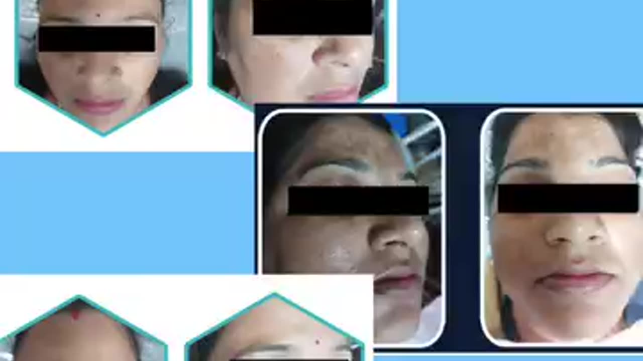 Achieve Radiant Skin with Hydra Facial Treatment in Mohali