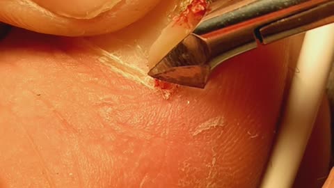 Removing ingrown toenail and growth plate