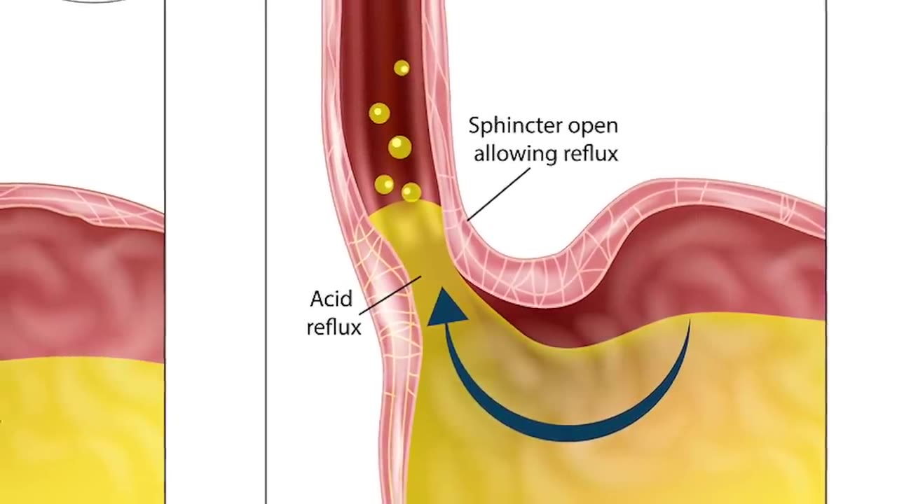 Reduce Your ACID REFLUX Immediately! Dr. Mandell