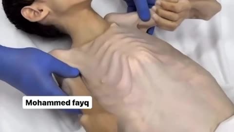 Palestinian child starved to death
