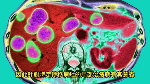 癌症擴散仍有希望！ 近年治療藥物進步