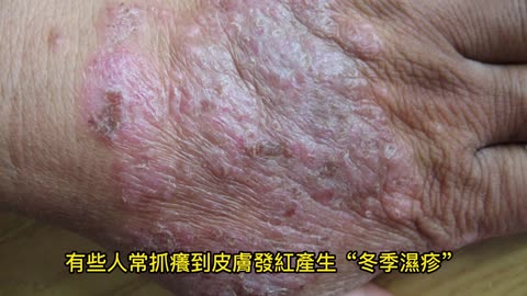 手指節皮膚龜裂 保濕避免「傷痕累累」