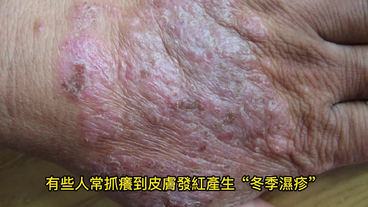 手指節皮膚龜裂 保濕避免「傷痕累累」