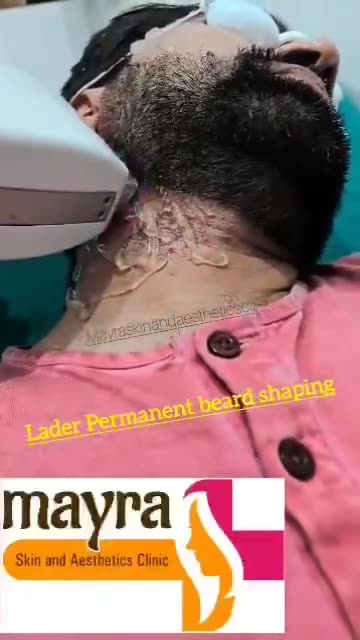 Laser Permanent Beard Shaping Treatment
