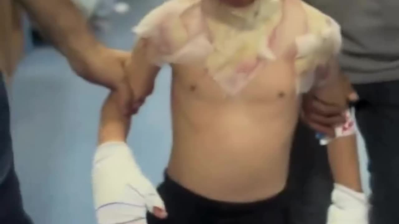 A young Palestinian boy is treated for severe burns as a result of Israeli missiles