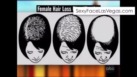 LaserCap for Hair Restoration