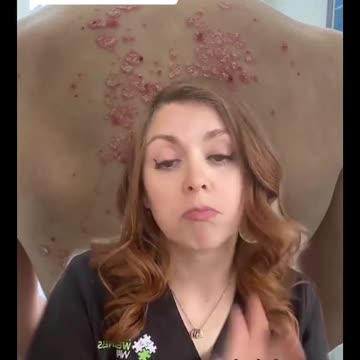 @The Wellness Way - Westminster, CO - Psoriasis is a multi-layered condition