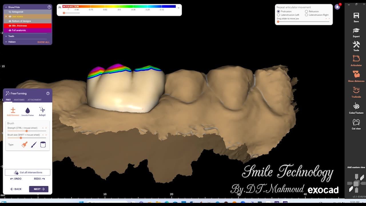 #design #naildesign #dental #dentaldesign #exocadexpert