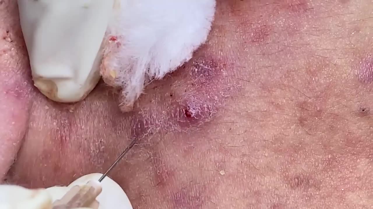 Acne Removal