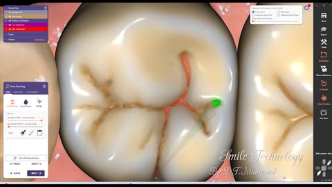 #design #naildesign #dental #dentaldesign #exocadexpert