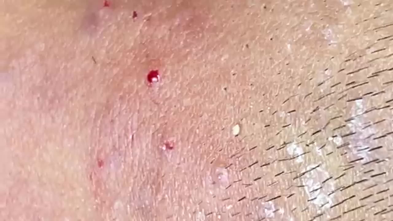 Relaxing Blackheads Removal