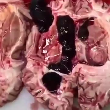 Thromboses in the brains of people killed by vaccine Source of the video: