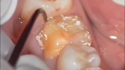 Removing crown