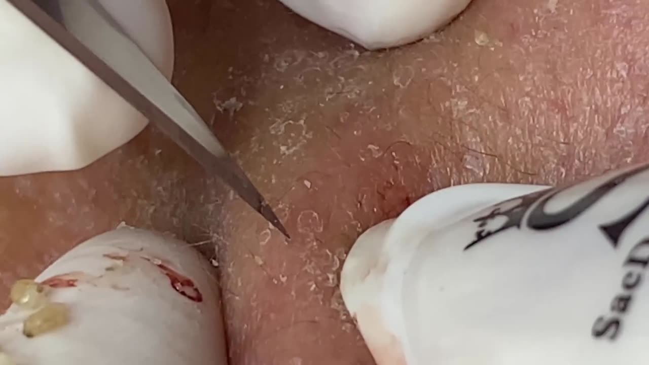 Extremely Terrible Blackhead Treatment At Sac Dep Spa