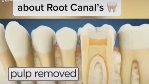 Dark Truth About Root Canals..