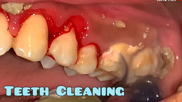 Tartar Removal | Teeth Cleaning | Teeth Cleaning by Doctor | Scaling of Teeth