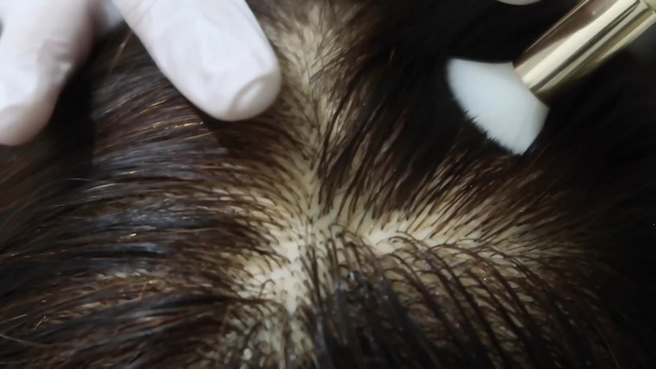 ASMR Scalp Check with Tweezers | Stress Relief and Sleep | No talking