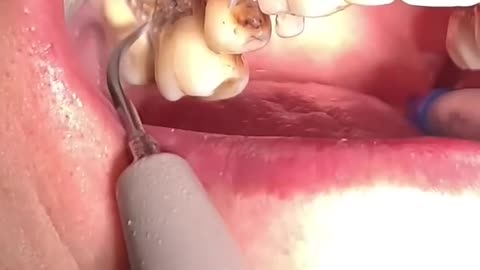 dental work on bad patients