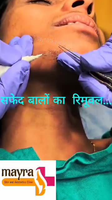 Reclaim Your Youth: White Hair Removal Treatment in Indore