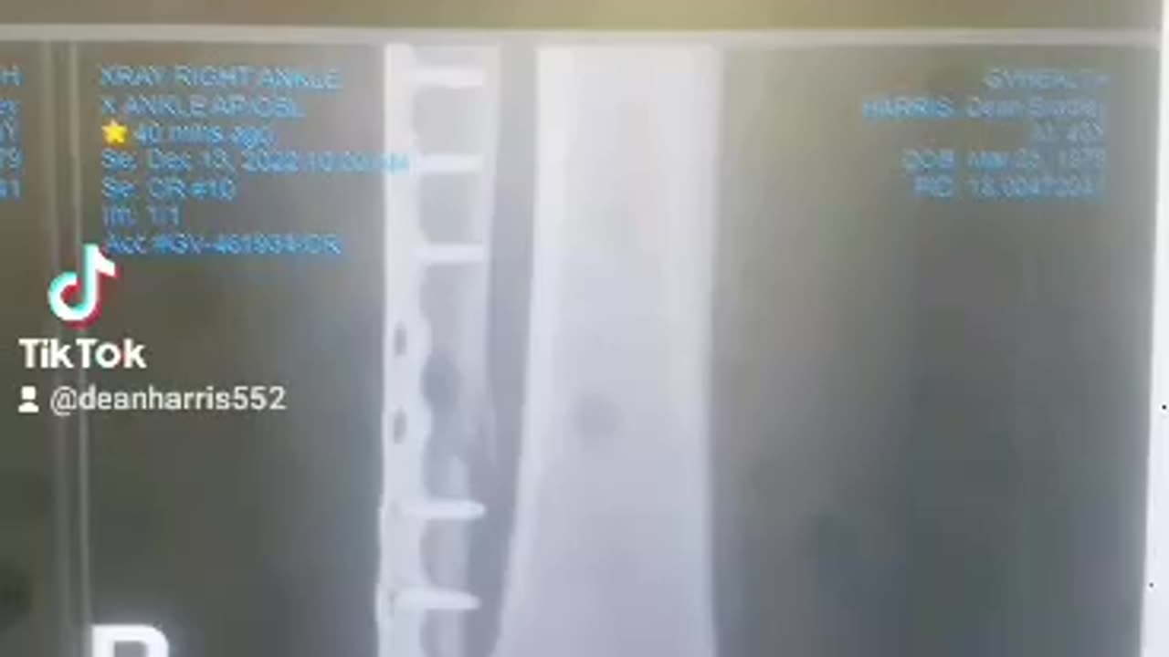 Broken leg and Ankle on a seizure