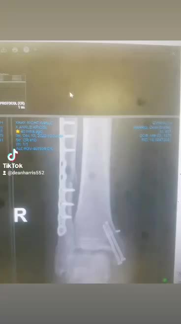 Broken leg and Ankle on a seizure