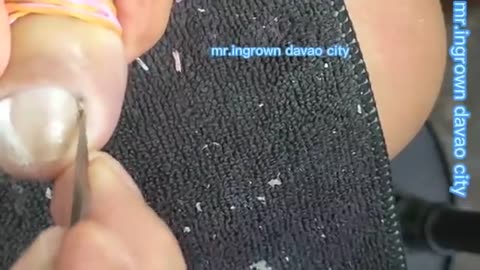 Removing BIG nail ingrown