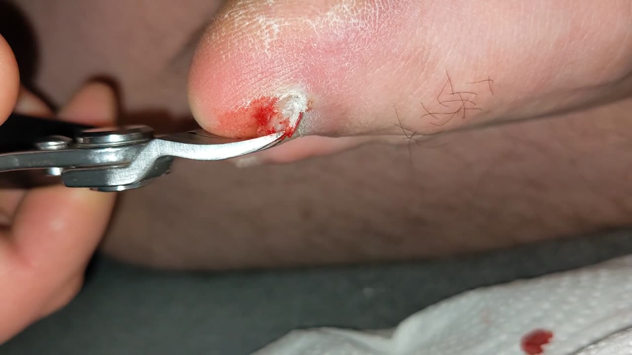 Damaged ingrown toenail removal