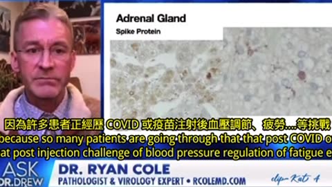 Dr. Ryan Cole 的最新驗屍突破性發現 刺突蛋白充滿了整個腎上腺 可能造成 POTS綜合徵和血壓/血糖問題等 甚至可以解釋心律失常！