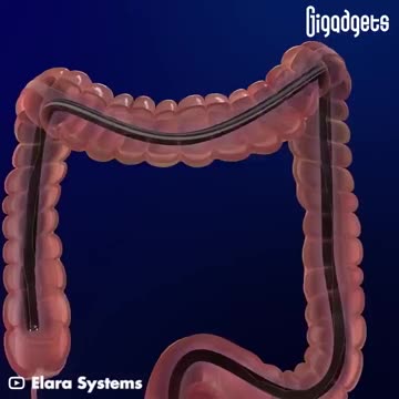 How a Colonoscopy is Done