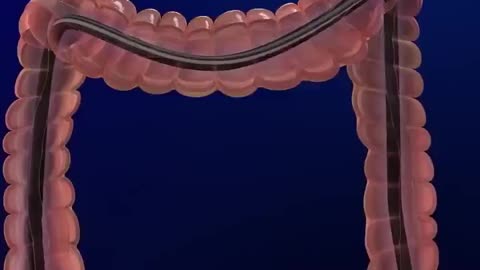 How a Colonoscopy is Done