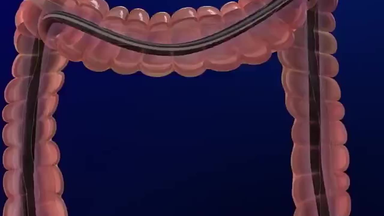 How a Colonoscopy is Done