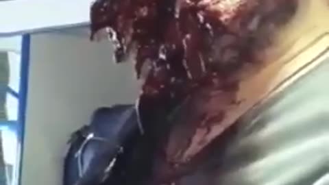 The Most Horrific War Wound I Have Ever Seen