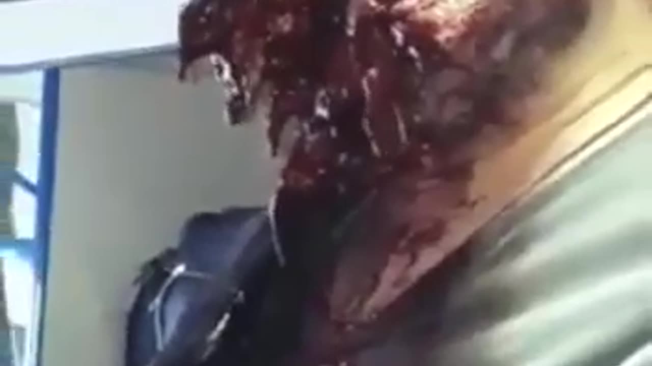 The Most Horrific War Wound I Have Ever Seen