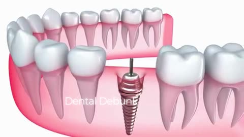 Tooth implant