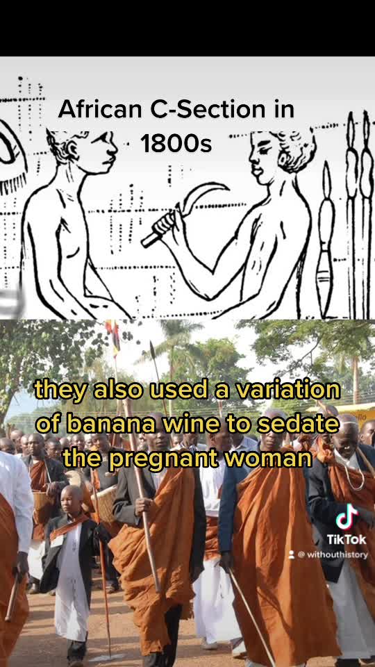 C-section in Africa in 1800s