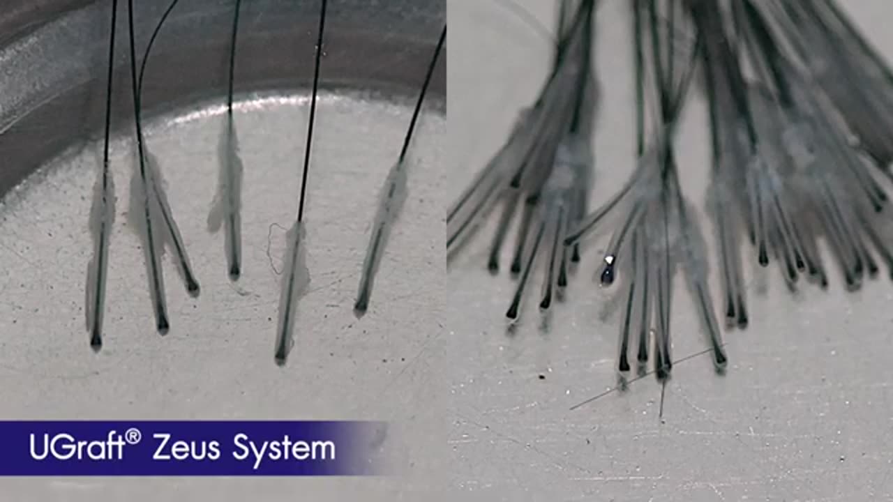 ปลูกผม Follicular Unit Excision ( FUE )