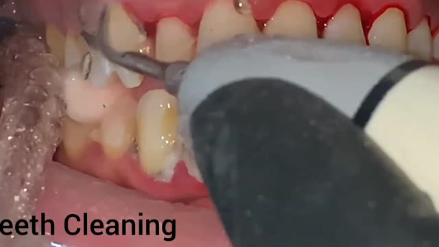 Teeth Cleaning | Scaling of Teeth | Tartar Cleaning