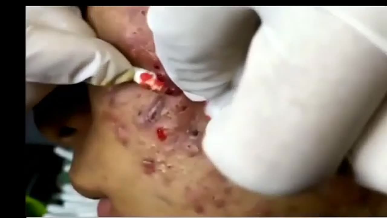 Black Head Acne removal