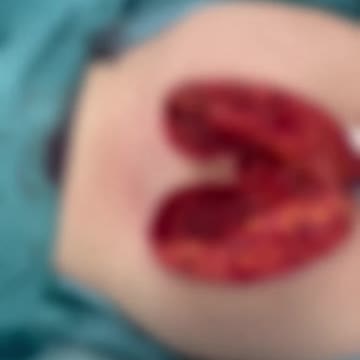 Lina Tejeiro confirma segunda cirugía de biopolimeros