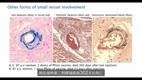 病理学家阿纳-布克哈特（Arne Burkhardt）最后的访谈：揭示 mRNA 疫苗的严重危害