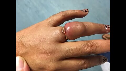 How to Safely Remove a Ring from a Swollen Finger