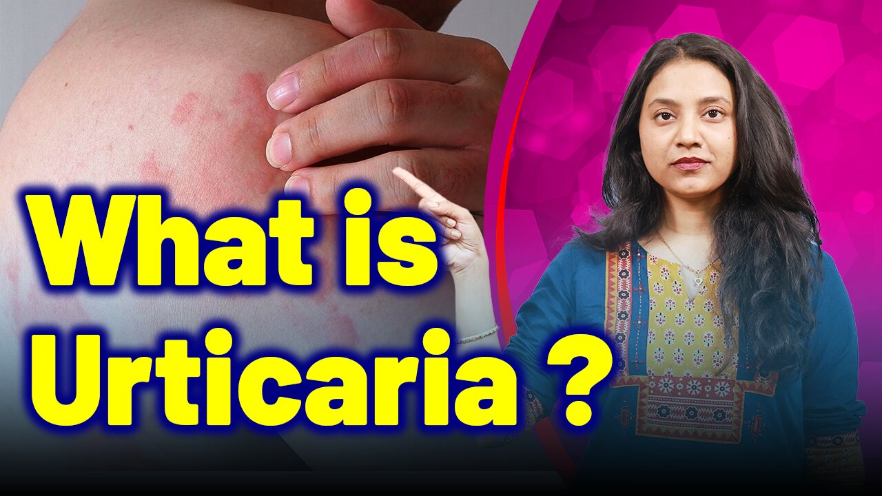 What is Urticaria, Nettle rash, Hives, Wheals ? | Treatment Cure | Homeopathy, Medicine & Surgery